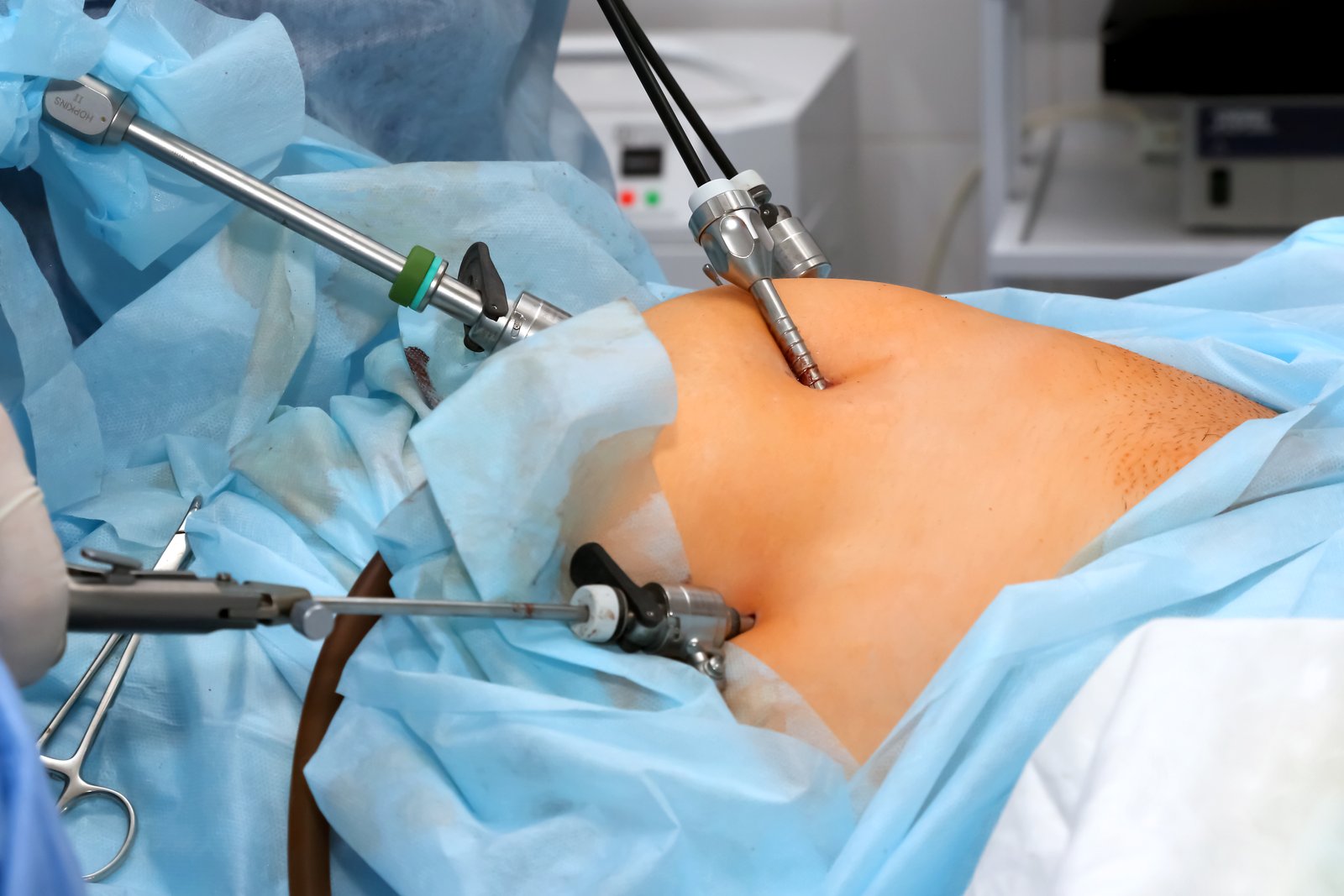Laparoscopy Surgery at Janani Hospital